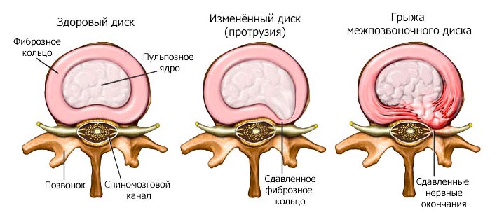 Протрузия диска